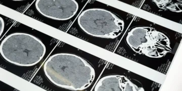 Veterinarian reviewing a brain MRI scan of a small breed puppy, highlighting reduced cerebral volume