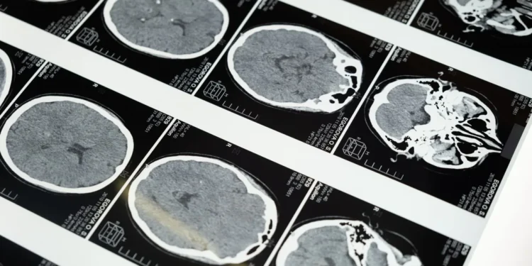 Veterinarian reviewing a brain MRI scan of a small breed puppy, highlighting reduced cerebral volume
